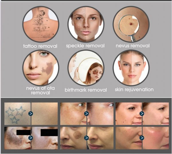 Ranger 2 -  Diode/YAG Laser - Image 12